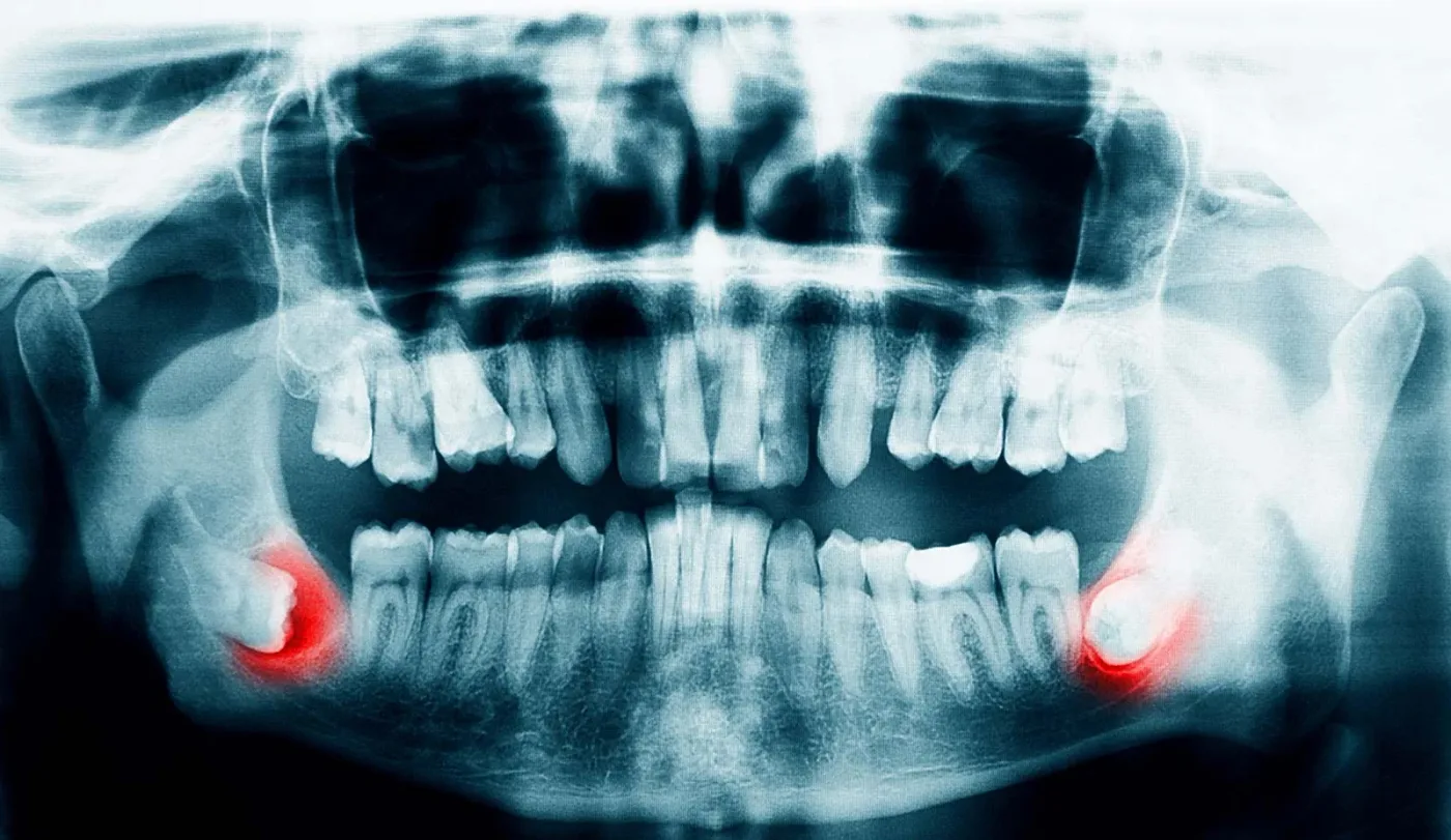 molar de minte main