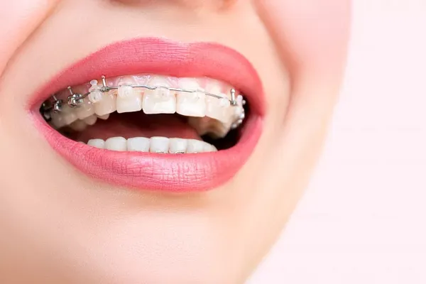 Aparat dentar ceramic la clinica Dentetico Brașov