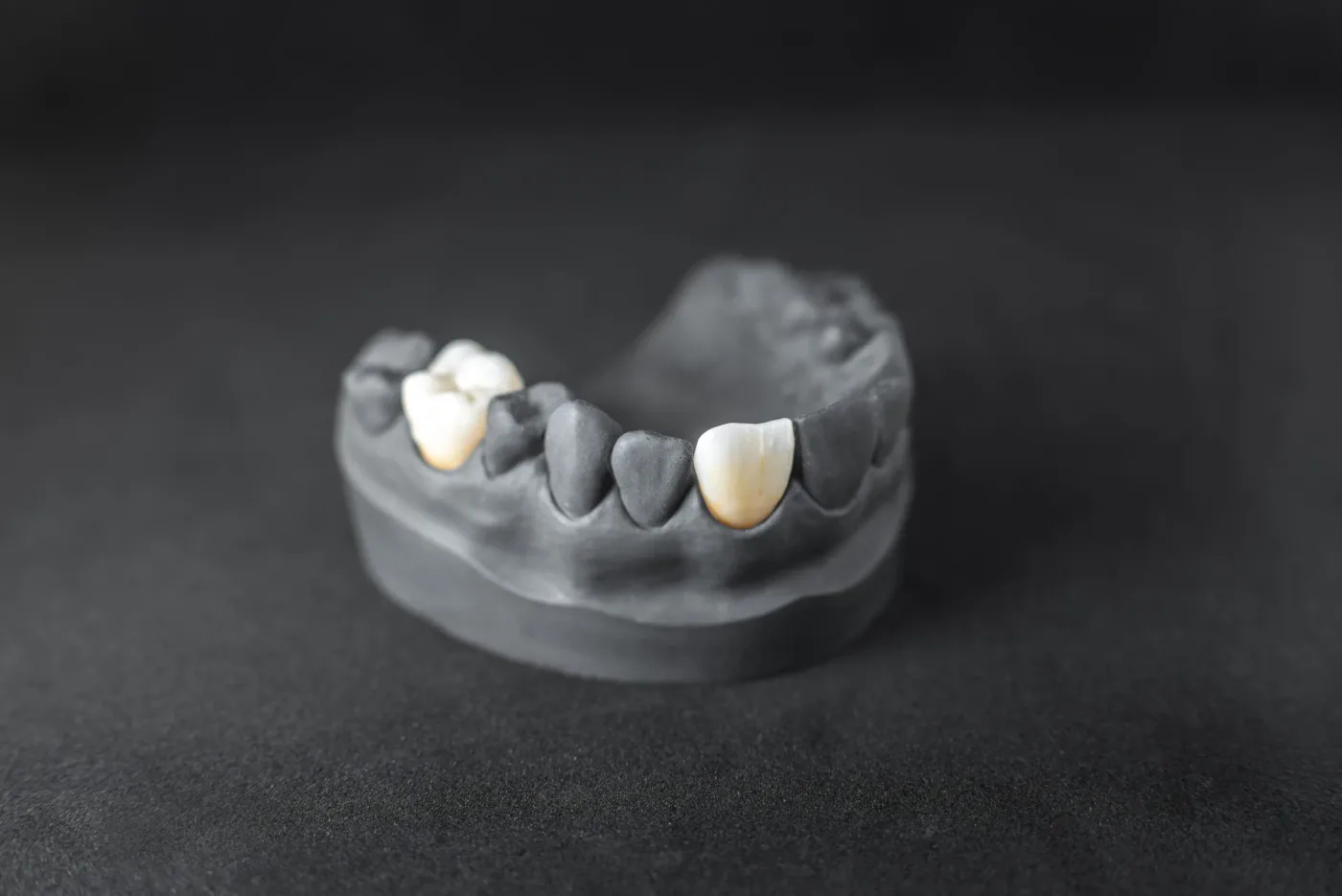 Care este rolul coroanelor dentare în procesul de implant dentar? Dentetico îți explică