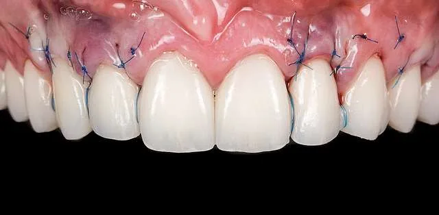 grefa gingivala