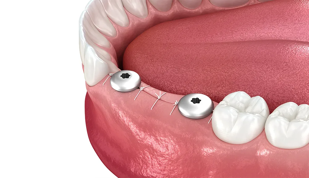 Clinica stomatologica Dentetico Brasov chirurgie dentara 1