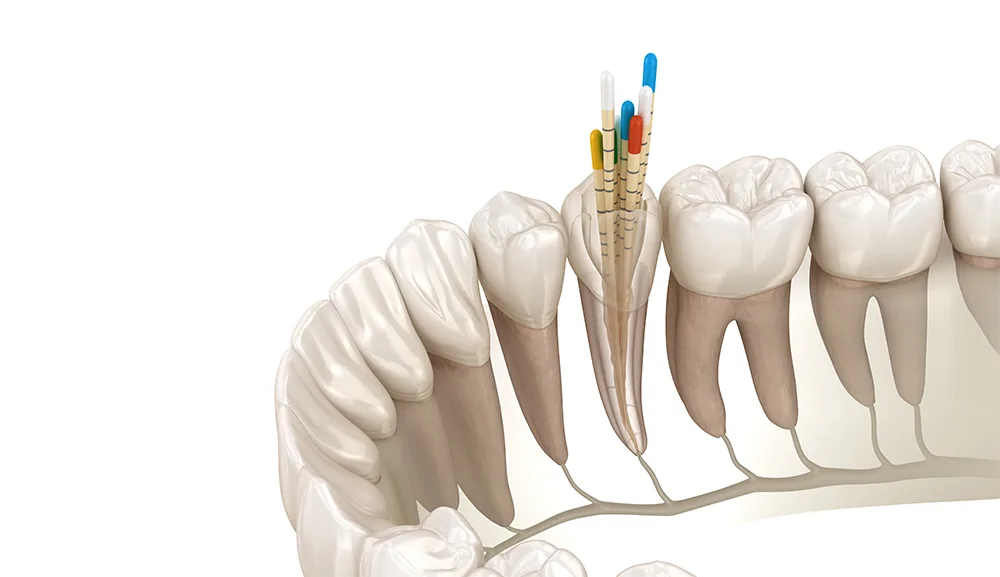Ilustrație tratament endodontic — curățarea canalelor radiculare