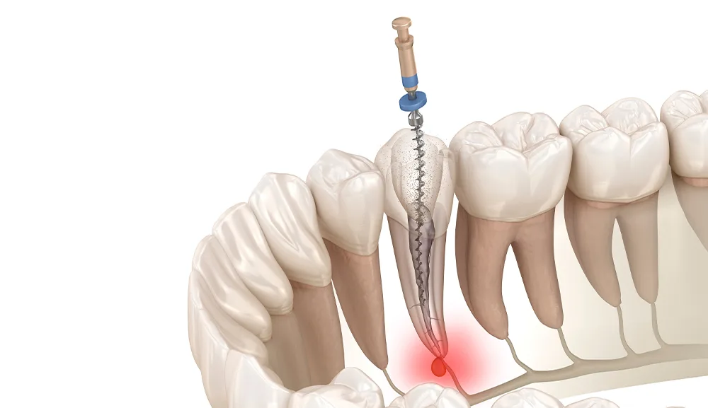Ilustrație tratament endodontic — obturarea și sigilarea canalului radicular