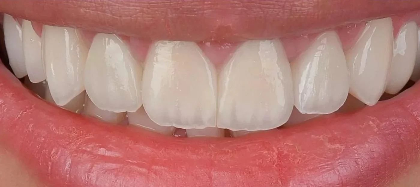 Beneficiile igienizării profesionale periodice. Dentetico lansează oferta Healthy Smile Friday