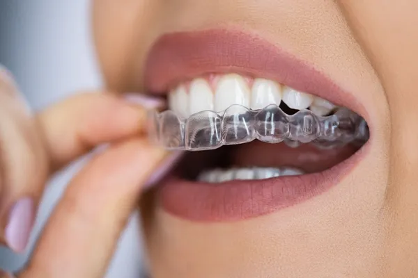 Aparat dentar invizibil Spark la clinica Dentetico Brașov
