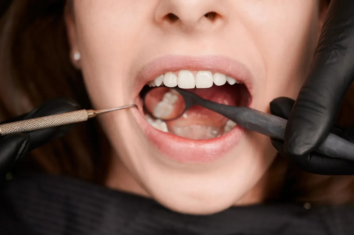 control stomatologic carie dentară