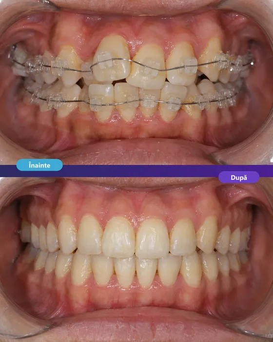 Tratament ortodontic cu aparat dentar estetic la Dentetico Brașov, înainte și după (2)